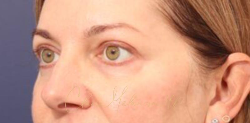Blepharoplasty Before & After Photo