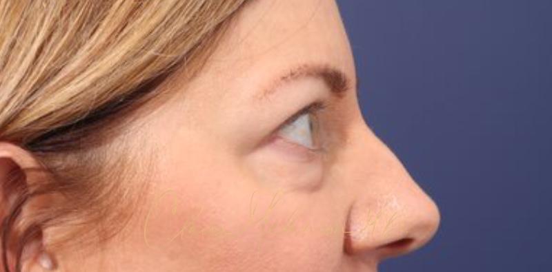 Blepharoplasty Before & After Photo