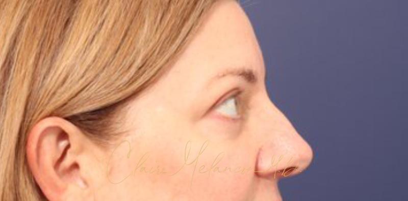 Blepharoplasty Before & After Photo