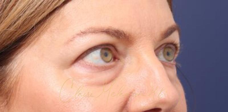 Blepharoplasty Before & After Photo