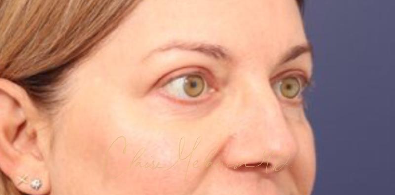 Blepharoplasty Before & After Photo