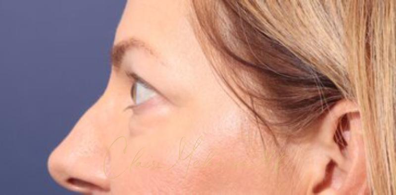 Blepharoplasty Before & After Photo