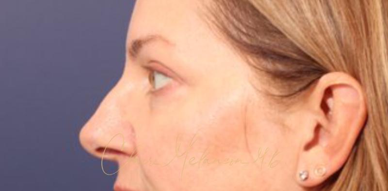 Blepharoplasty Before & After Photo