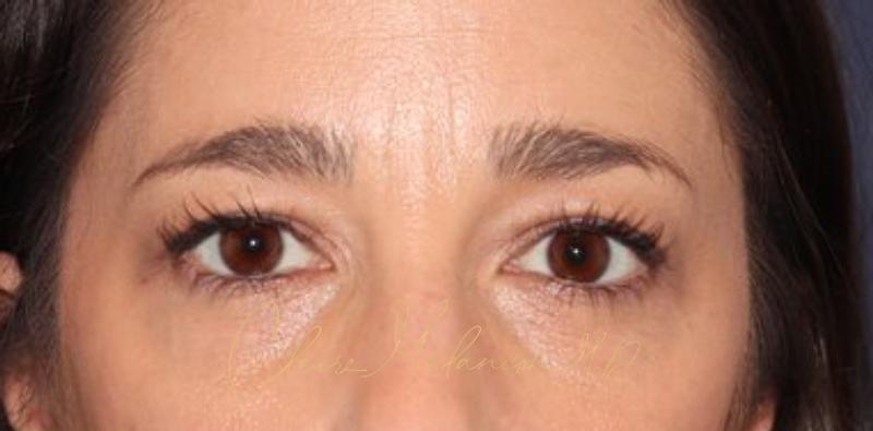 Blepharoplasty Before & After Photo