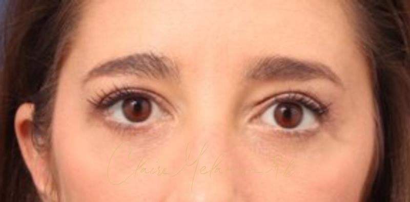 Blepharoplasty Before & After Photo