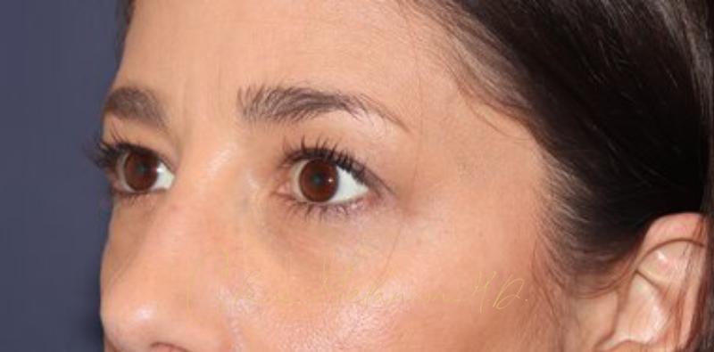 Blepharoplasty Before & After Photo