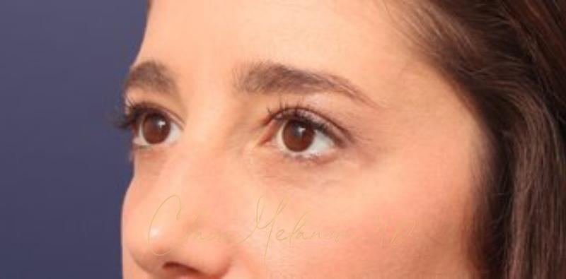 Blepharoplasty Before & After Photo