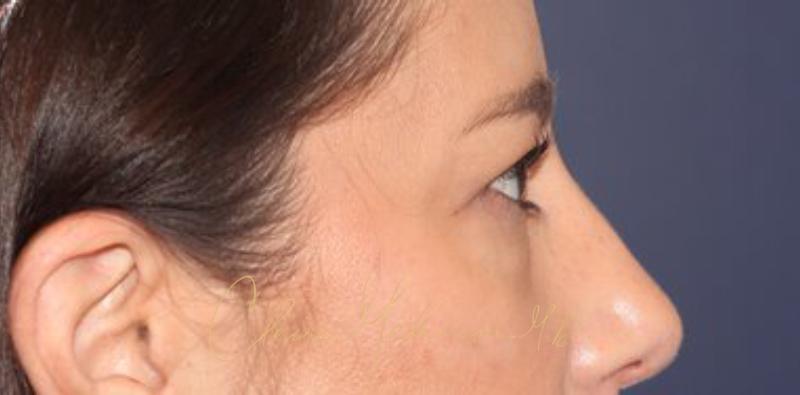 Blepharoplasty Before & After Photo