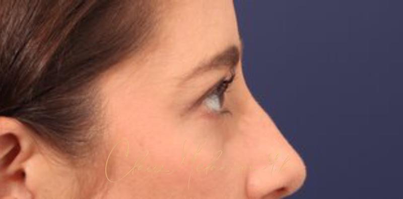 Blepharoplasty Before & After Photo