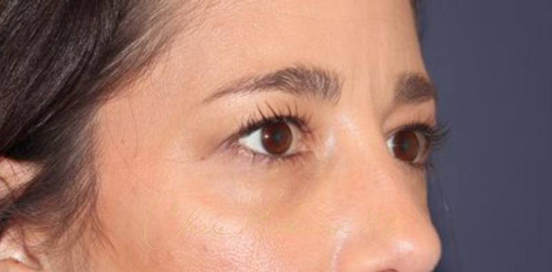 Blepharoplasty Before & After Photo