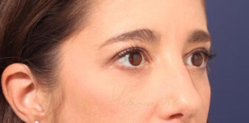 Blepharoplasty Before & After Photo