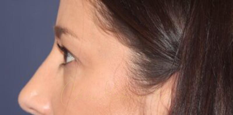 Blepharoplasty Before & After Photo