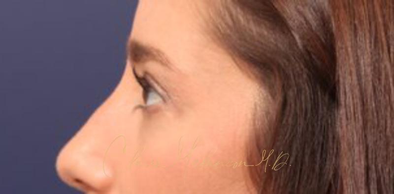 Blepharoplasty Before & After Photo