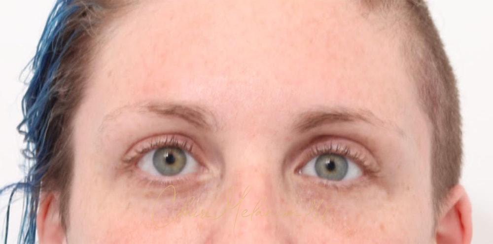Brow Lift Before & After Photo