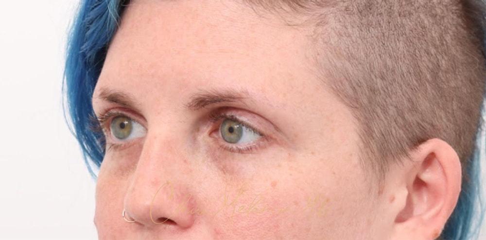 Brow Lift Before & After Photo