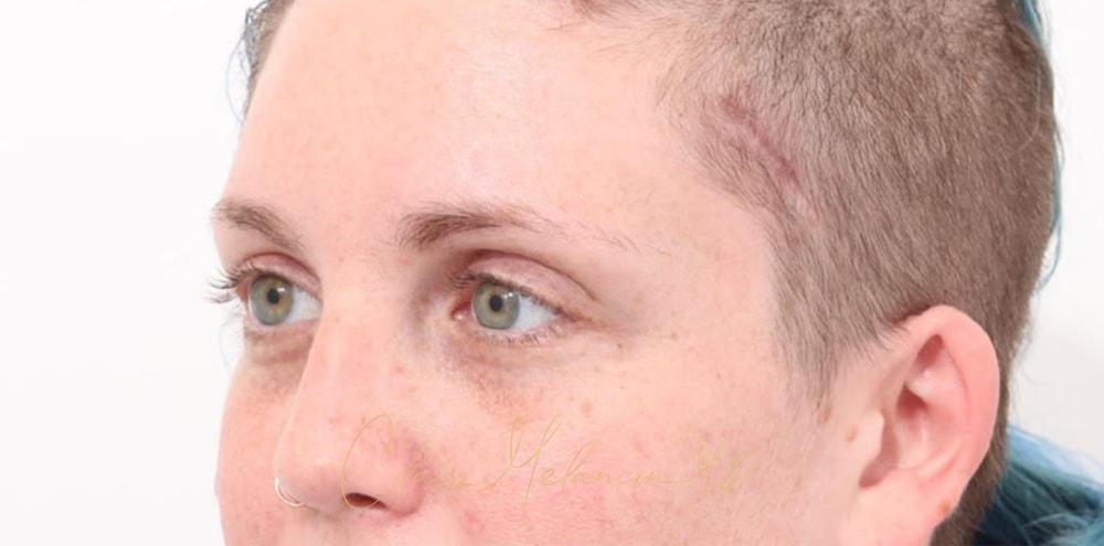 Brow Lift Before & After Photo