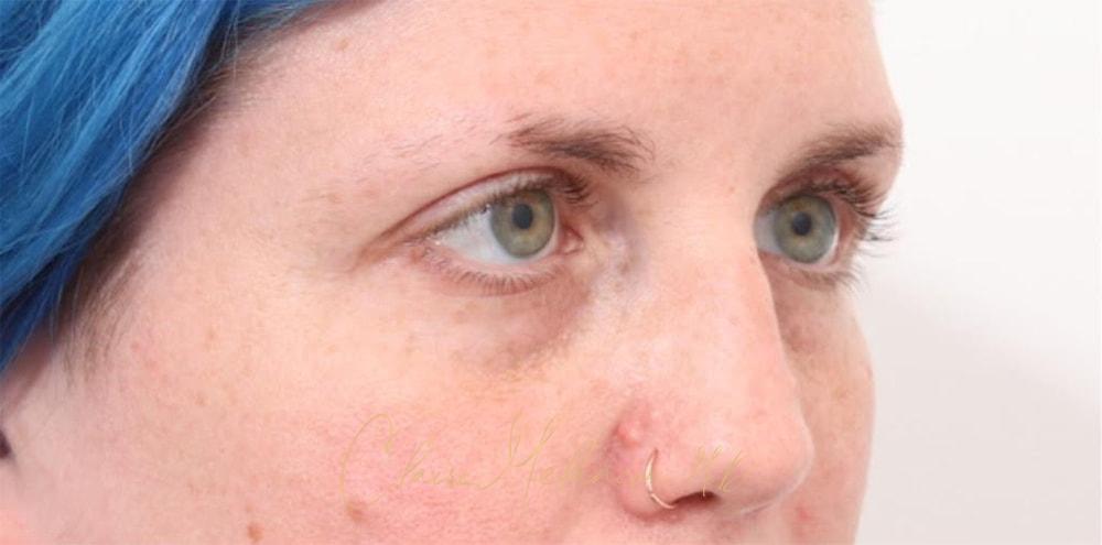 Brow Lift Before & After Photo
