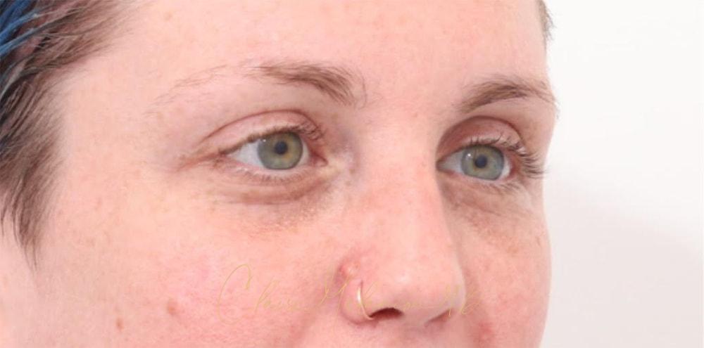 Brow Lift Before & After Photo