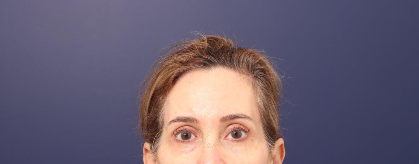Brow Lift Before & After Photo