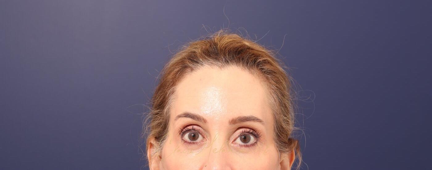 Brow Lift Before & After Photo