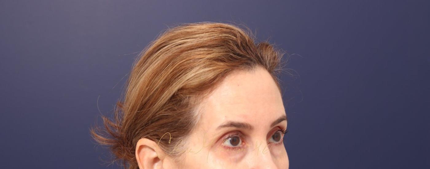 Brow Lift Before & After Photo