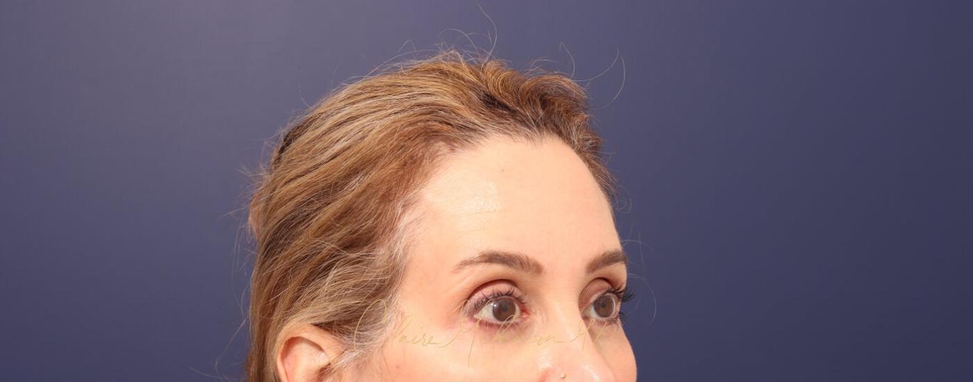 Brow Lift Before & After Photo