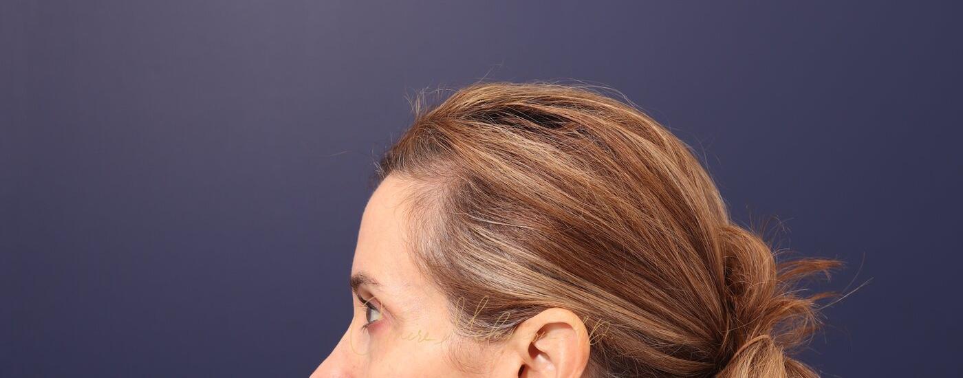 Brow Lift Before & After Photo