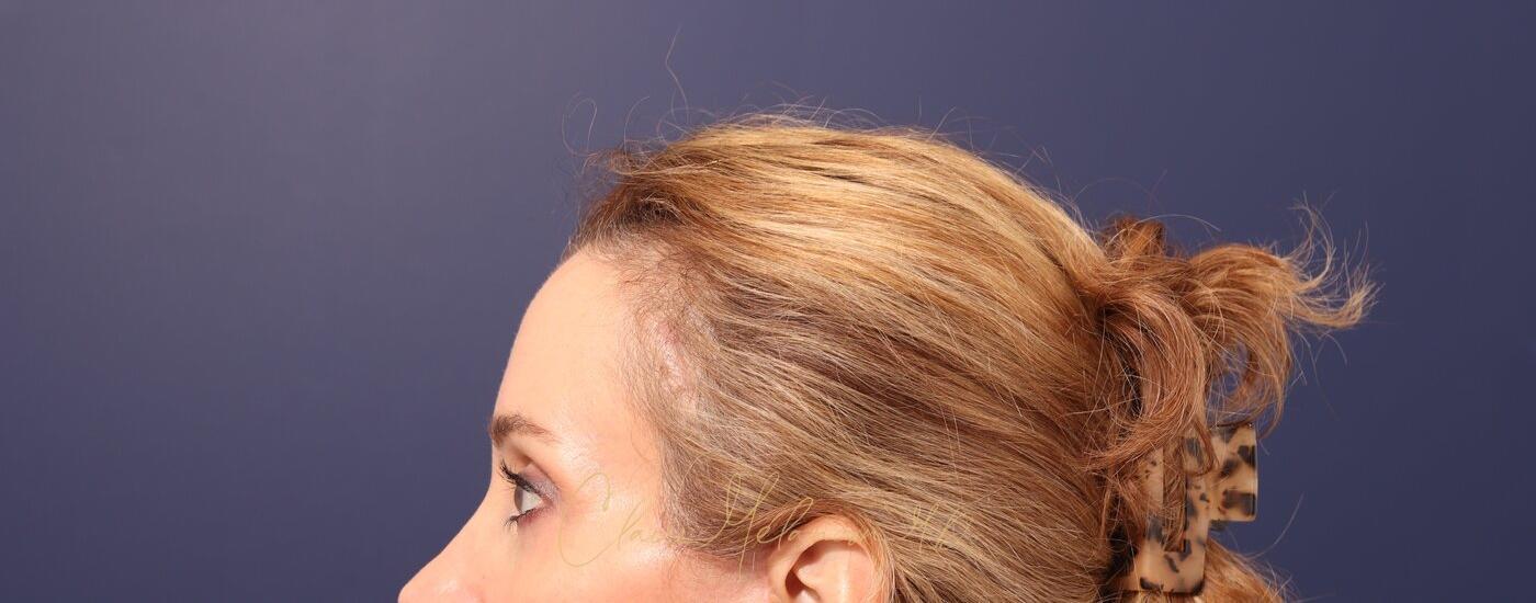 Brow Lift Before & After Photo