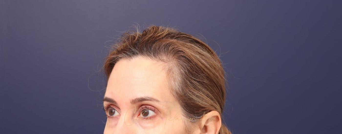 Brow Lift Before & After Photo