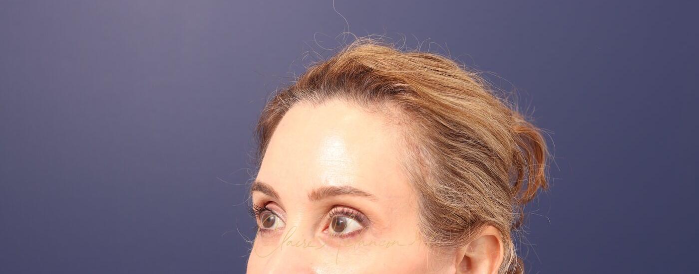Brow Lift Before & After Photo