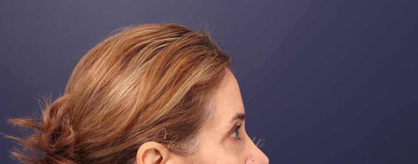 Brow Lift Before & After Photo