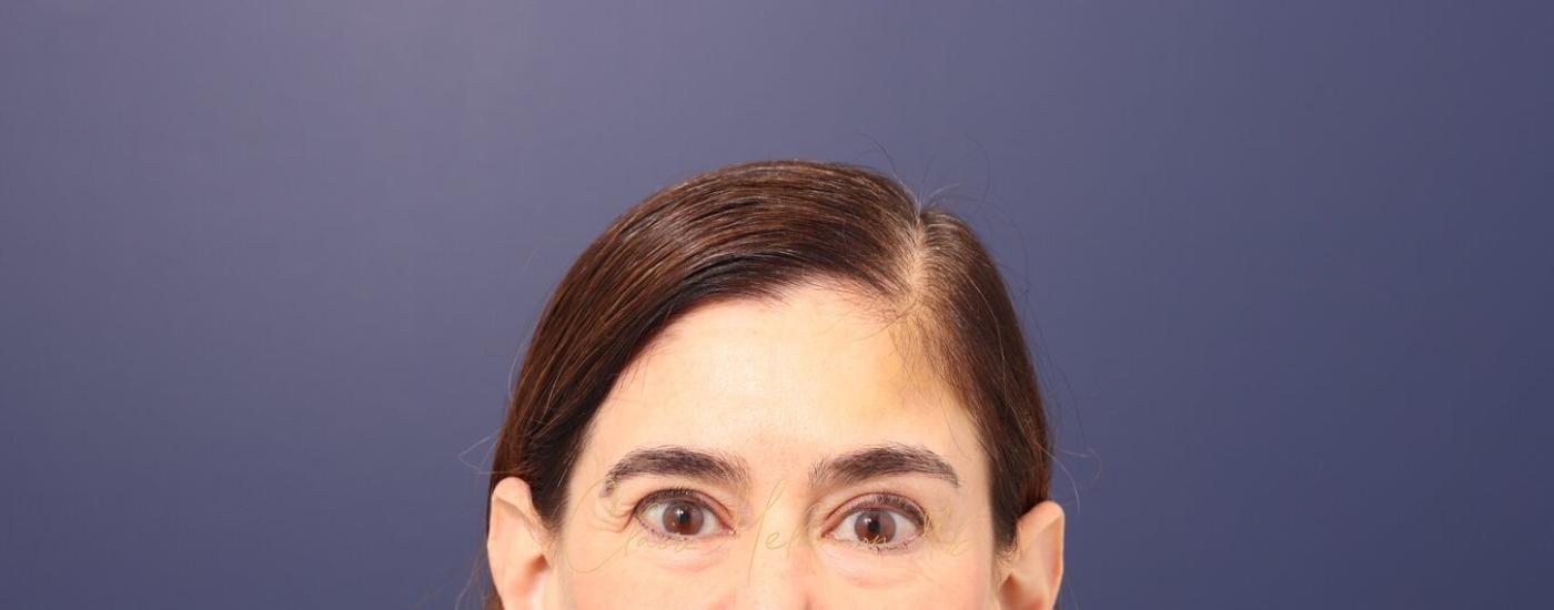 Brow Lift Before & After Photo