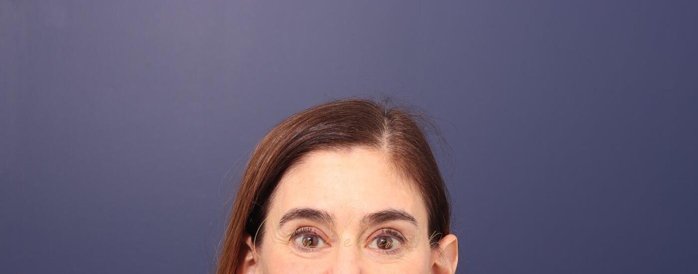 Brow Lift Before & After Photo