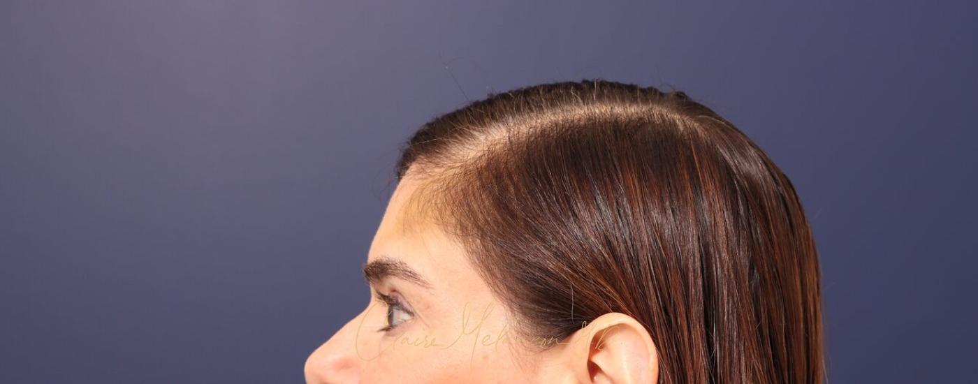 Brow Lift Before & After Photo