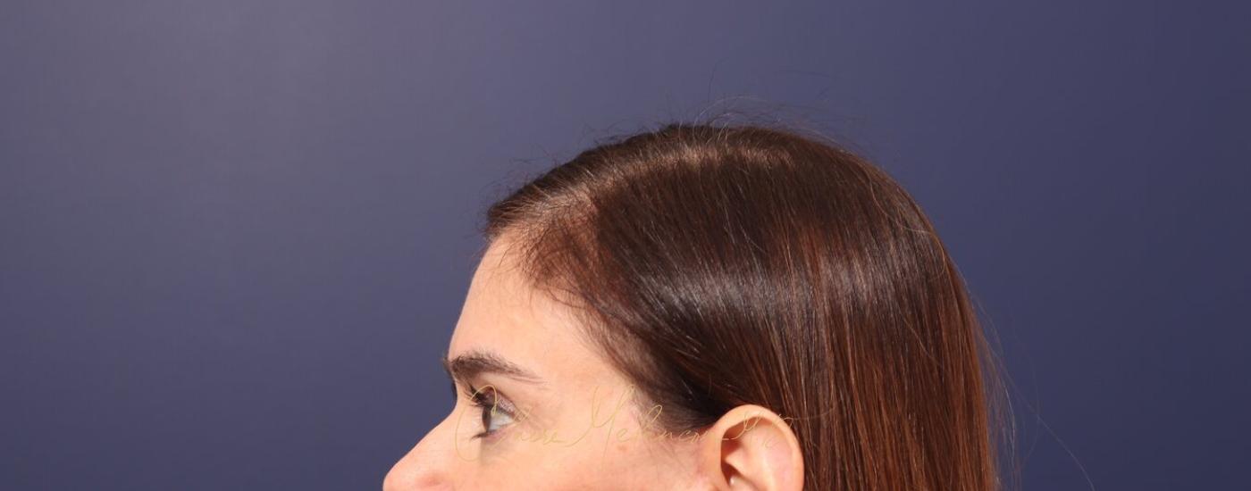 Brow Lift Before & After Photo