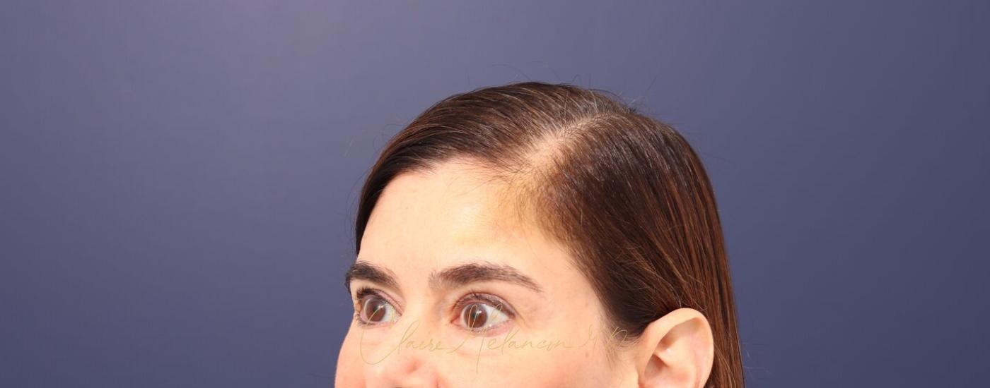 Brow Lift Before & After Photo