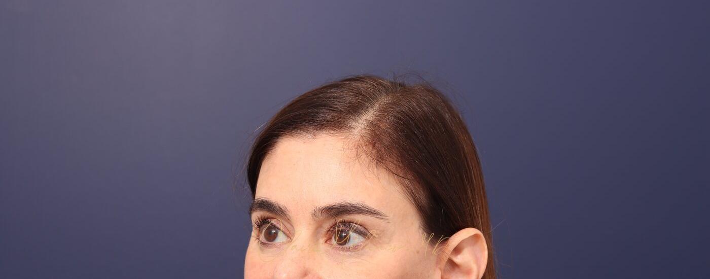 Brow Lift Before & After Photo