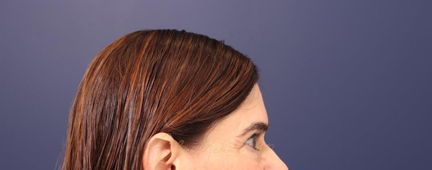 Brow Lift Before & After Photo