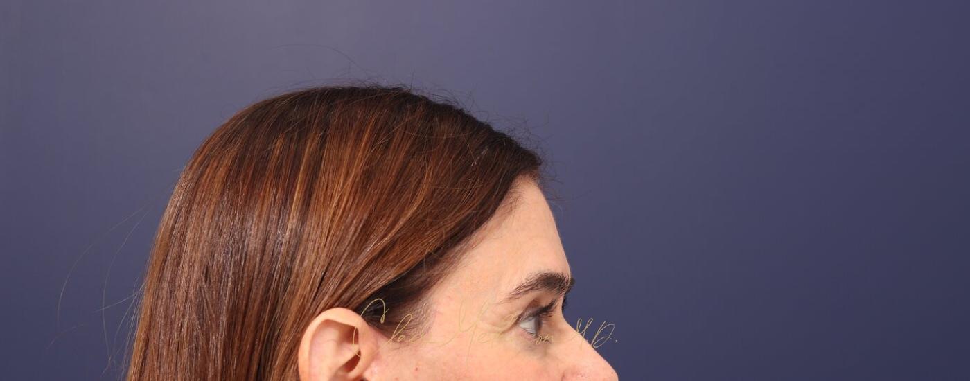 Brow Lift Before & After Photo