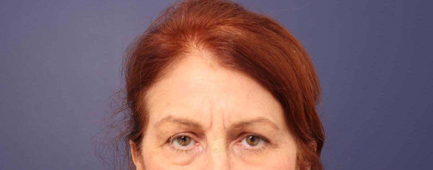 Brow Lift Before & After Photo