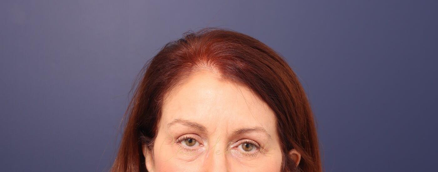 Brow Lift Before & After Photo
