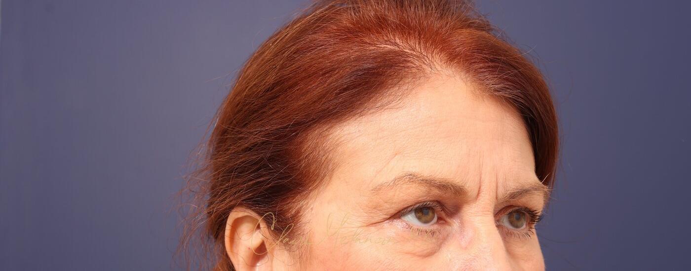 Brow Lift Before & After Photo