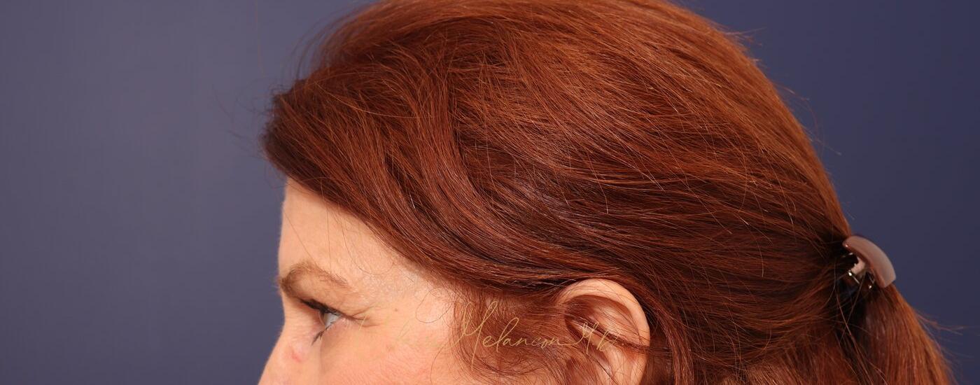 Brow Lift Before & After Photo
