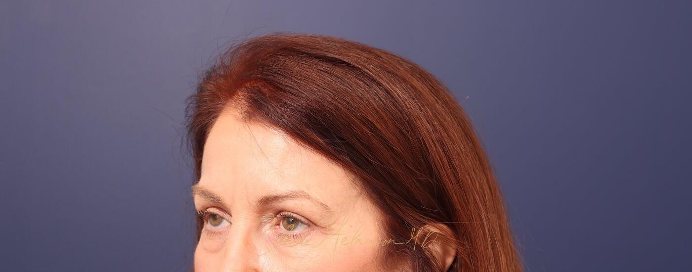 Brow Lift Before & After Photo