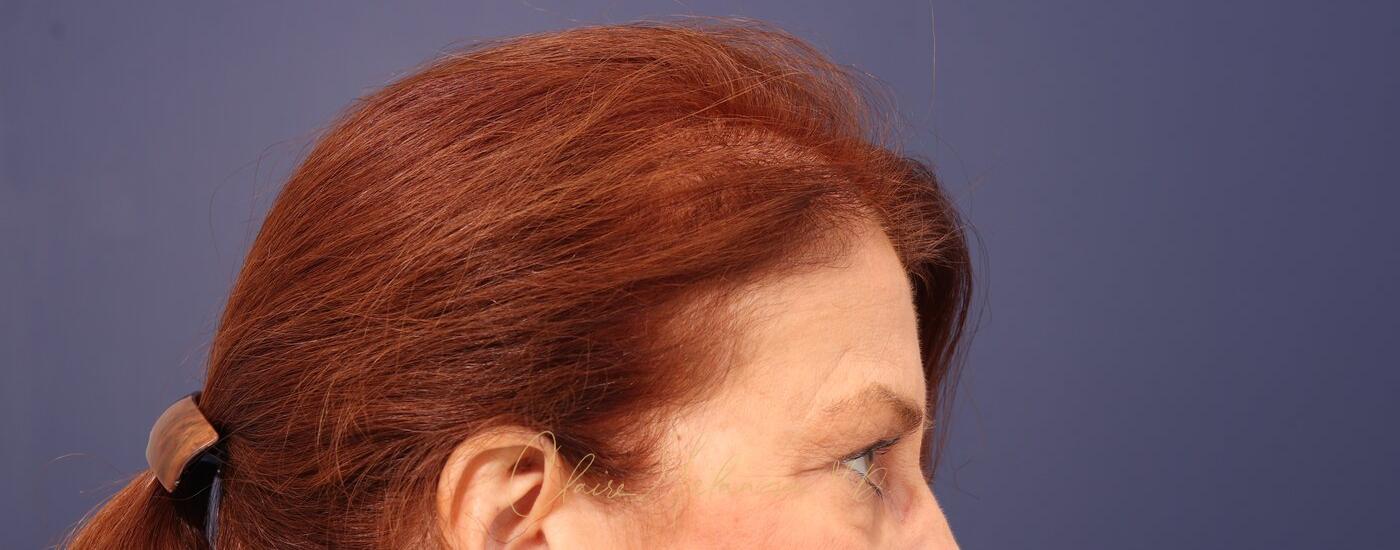Brow Lift Before & After Photo