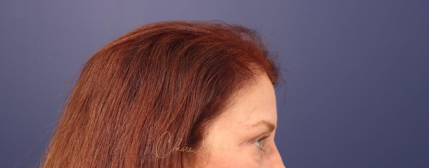 Brow Lift Before & After Photo