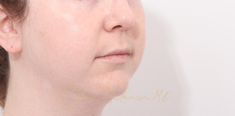 Buccal Fat Removal Before & After Photo