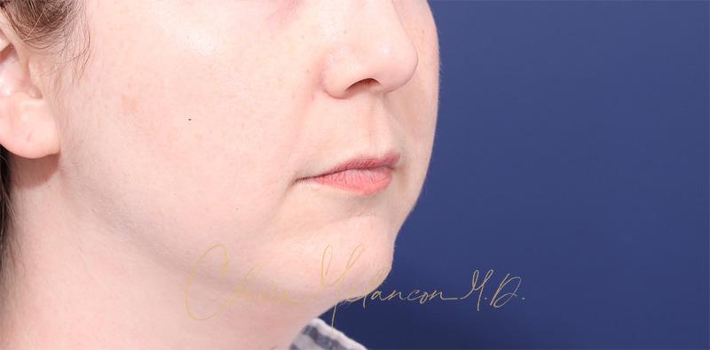 Buccal Fat Removal Before & After Photo