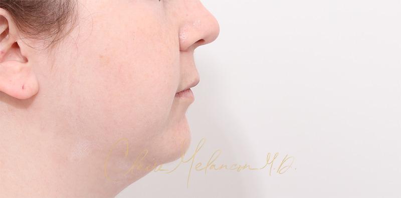 Buccal Fat Removal Before & After Photo