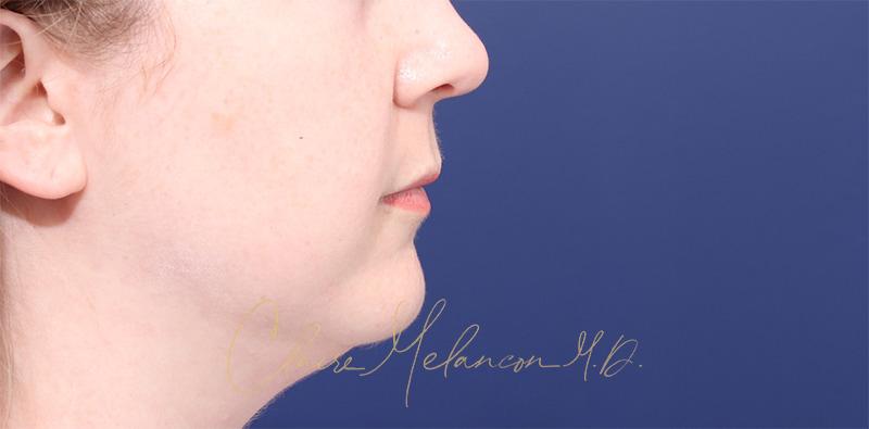 Buccal Fat Removal Before & After Photo